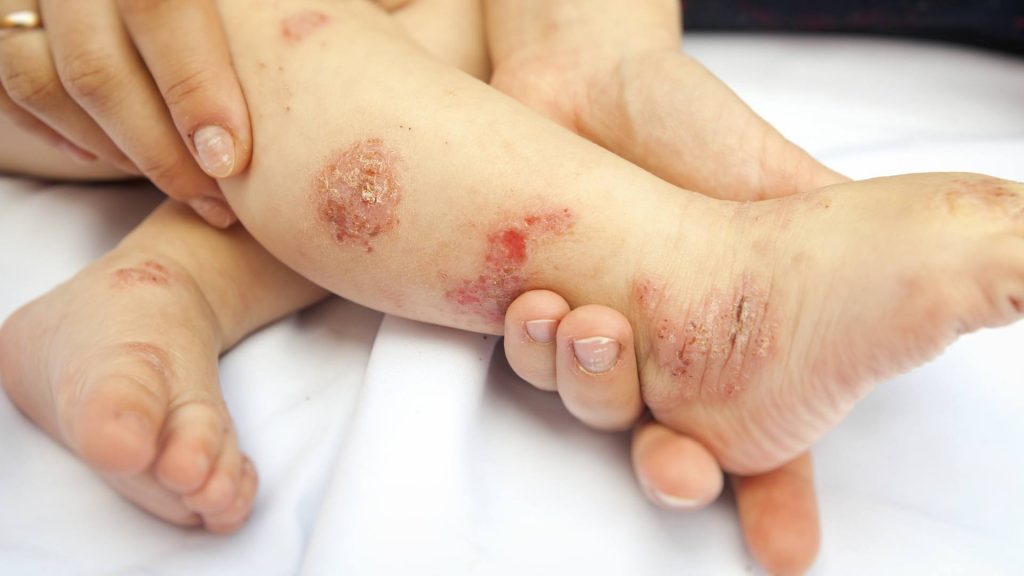 Le point sur l’allergie aux protéines du lait de vache chez l’enfant Cerin