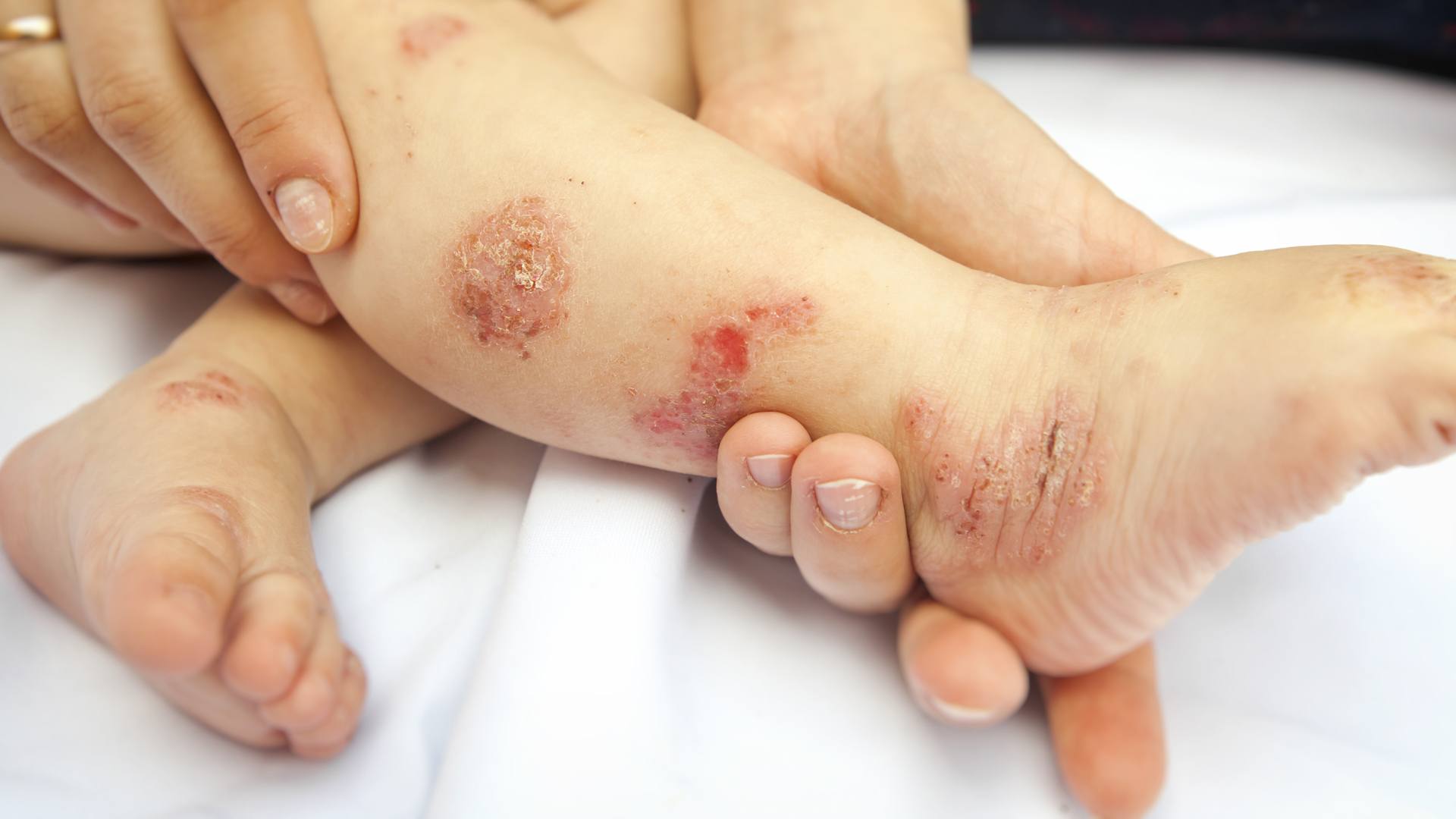 Le Point Sur L Allergie Aux Proteines Du Lait De Vache Chez L Enfant Cerin Le Point Sur L Allergie Aux Proteines Du Lait De Vache Chez L Enfant Cerin