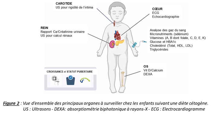 Le régime cétogène dans les épilepsies pharmacorésistantes de l'enfant